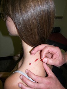 Fine needles placed around a patient's shoulder